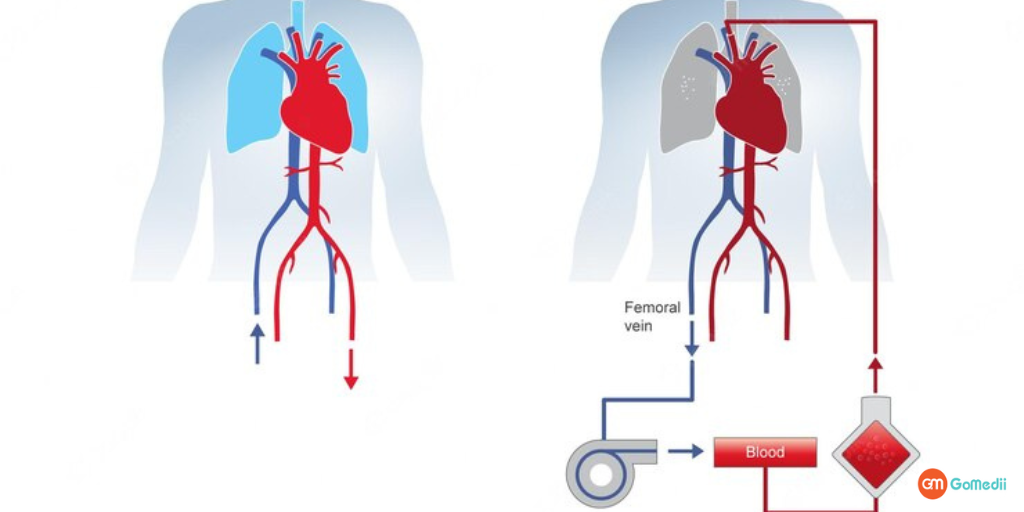 जाने एक्स्ट्राकोर्पोरियल मेम्ब्रेन ऑक्सीजनेशन (ECMO) क्या है?
