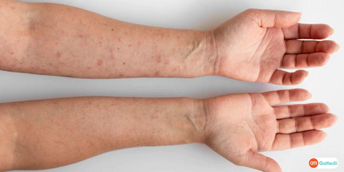 जाने अप्लास्टिक एनीमिया के लक्षण,Aplastic Anemia ke lakshan in Hindi