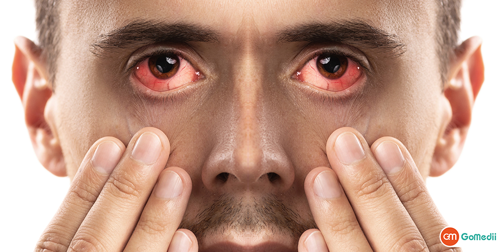 eye flu ke lakshan in hindi - GoMedii