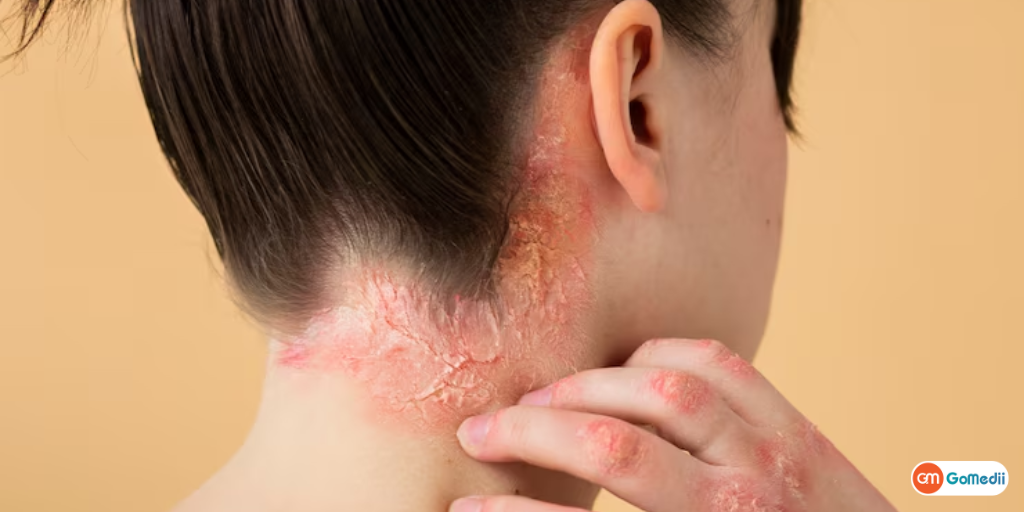 Clade 1b स्ट्रेन से बढ़ता Mpox Virus का खतरा, जानें इसके 5 चिंताजनक पहलू