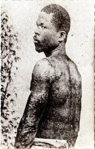 RPPC Repro Martinique PRISON SURVIVOR~1902 MOUNT PELEE VOLCANO ERUPTION Postcard