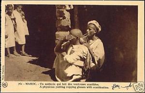 morocco Physician putting Cupping Glasses SCARIFICATION