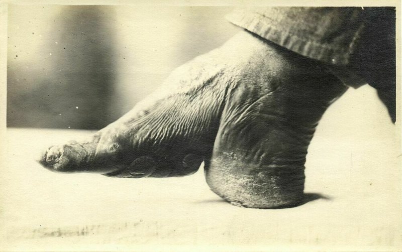 china, Result of Bounding Feet, Foot Binding (1910s) Real Photo