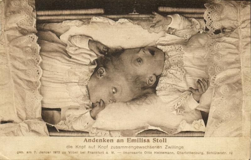 Conjoined Siamese Head-to-Head Twins Emilisa Stoll (1912) Freak Postcard