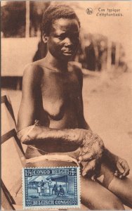 Congo Typical Case of Elephantiasis Postcard 03.19