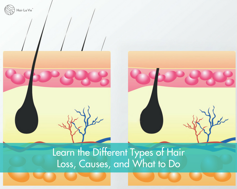 The types of hair loss, how to prevent or stop it & remedies