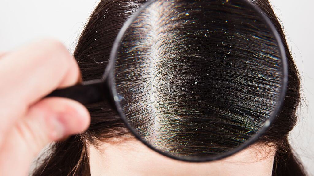 Managing dry scalp and dandruff | Hair La Vie Managing dry scalp and dandruff | Hair La Vie