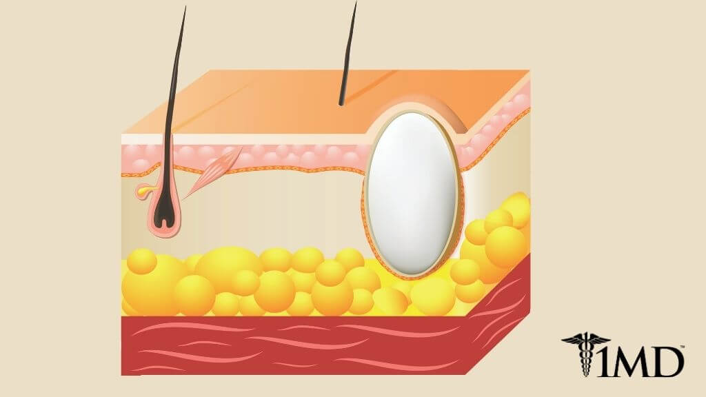 What's a Sebaceous Cyst? Signs, Treatments, and What to Expect 1MD