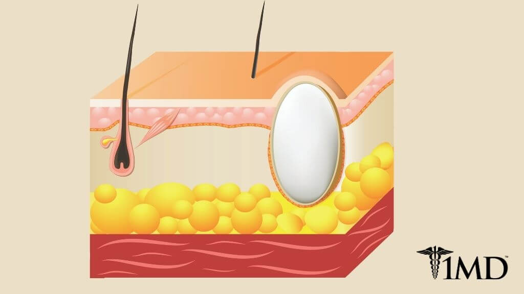 what-s-a-sebaceous-cyst-signs-treatments-and-what-to-expect-1md