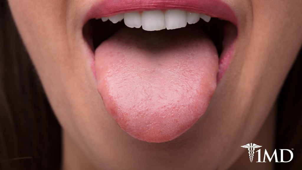 White Tongue: Can Probiotics Help This Common Digestive Health Issue ...