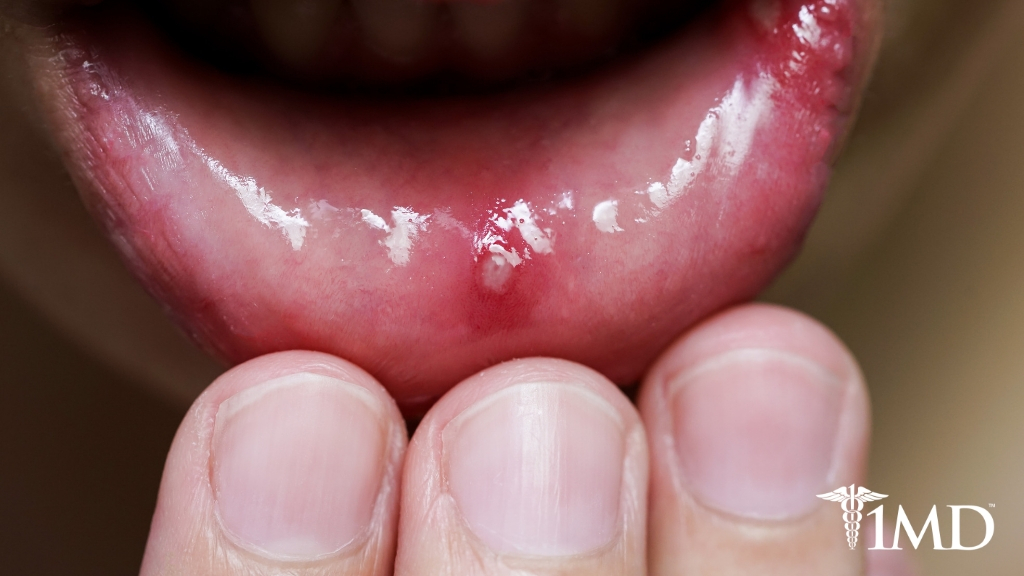 how-to-tell-if-it-s-a-canker-sore-cold-sore-or-more-serious-1md