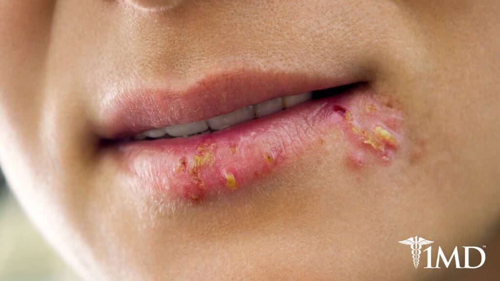 Cold Sores: The Causes and Symptoms + How to Prevent and Treat Them