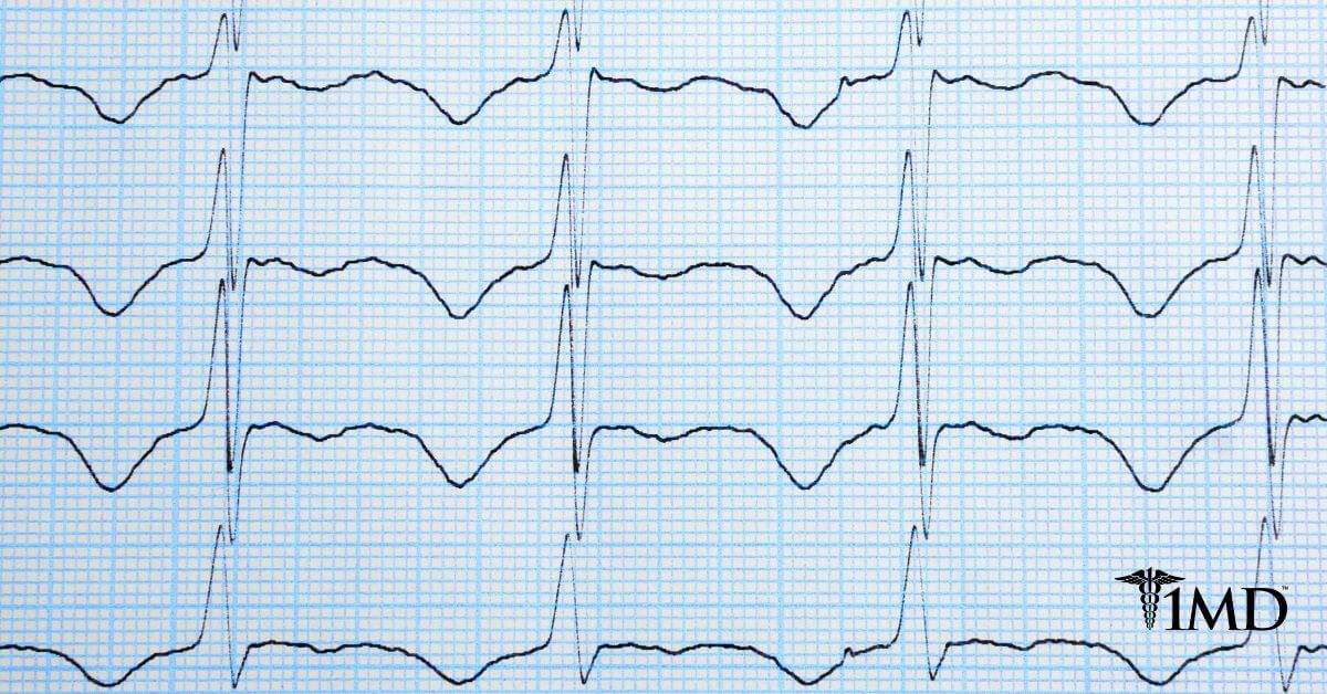 irregular heartbeat symptoms