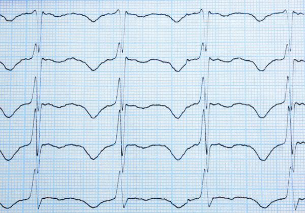 regular irregular heartbeat