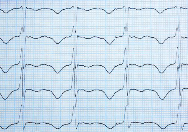 Irregular Heartbeat Symptoms - Heart Symptoms - 1MD