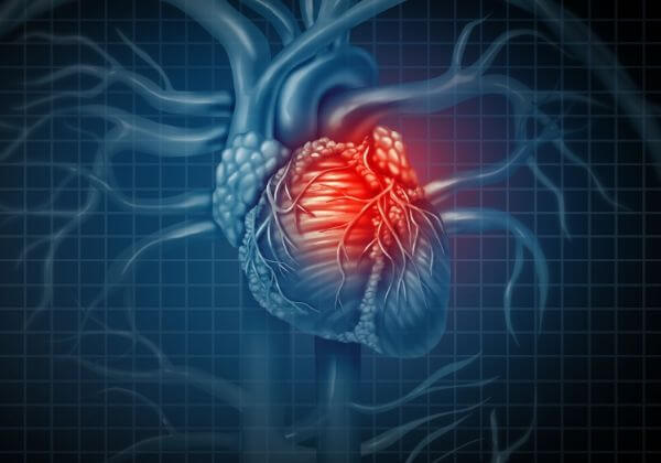 Heart Attack: Symptoms, Treatment, and Long-Term Outlook