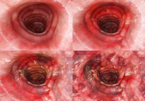 What Is Ulcerative Colitis?