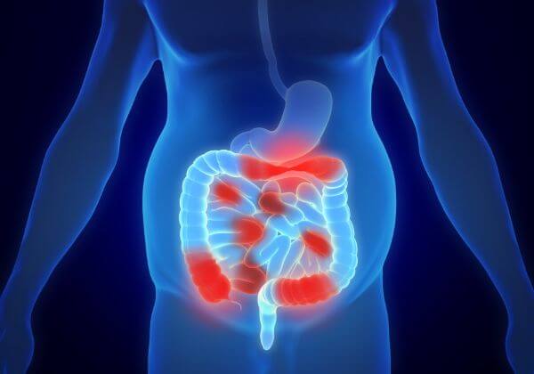 What is Crohn's Disease - Digestion - 1MD