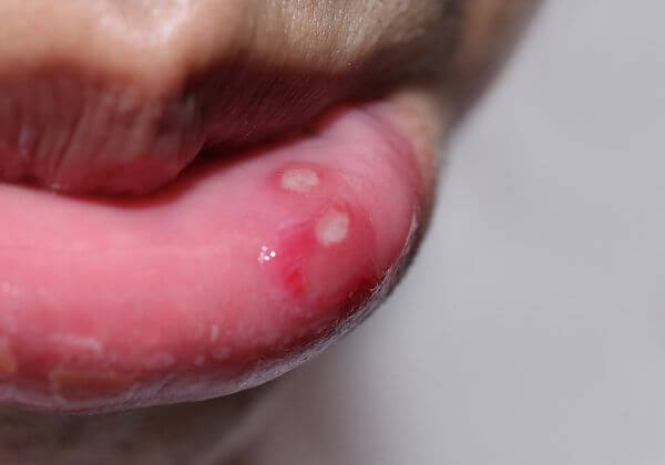 What Causes Canker Sores