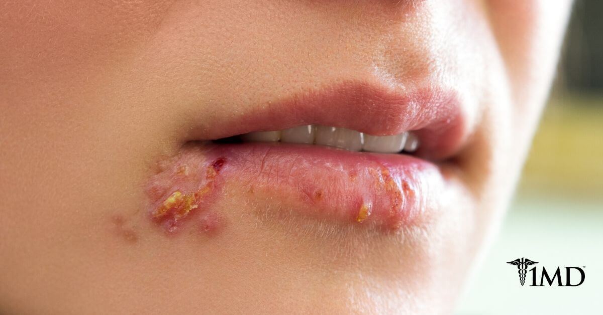 Cold Sore Treatment 1md