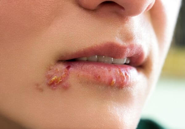 How To Get Rid Of A Cold Sore - Immunity - 1MD