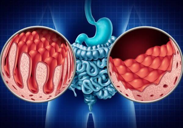 What Is Celiac Disease - Immunity - 1MD