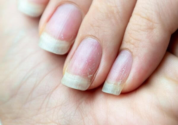 Why Are My Fingernails Brittle - Joint - 1MD