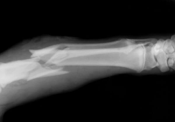 What Causes Broken Bones?