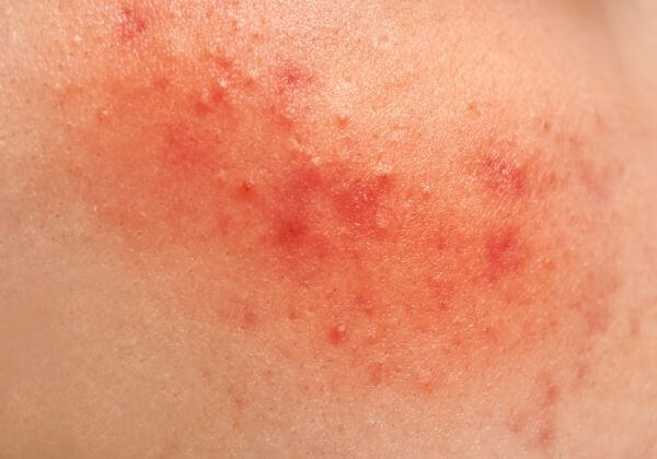 Skin Problems - Joint - 1MD