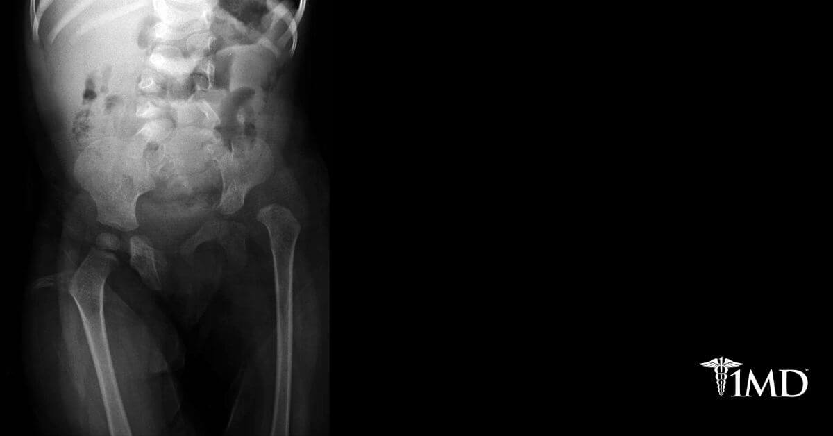 Hip Dysplasia Causes, Diagnosis, and Surgery 1MD