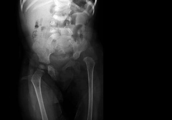 Hip Dysplasia: Causes, Diagnosis, and Surgery
