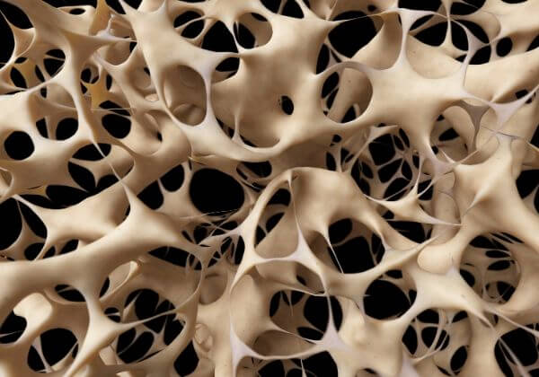 Osteoporosis: Symptoms, Treatments, and Long-Term Outlook