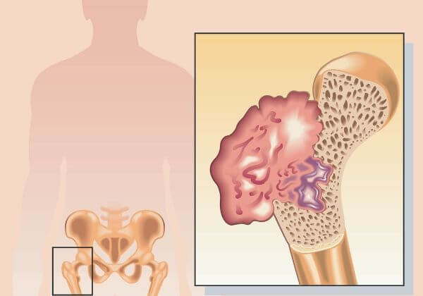 Osteosarcoma: Causes, Symptoms, and Natural Treatments