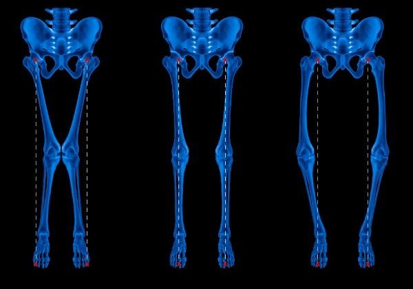 Rickets: Causes, Symptoms, and Long-Term Outlook