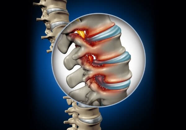 Spinal Stenosis: Symptoms, Diagnosis, and Variations