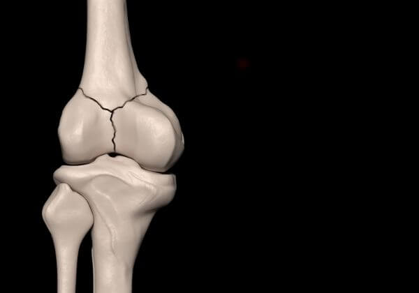 Bone Fracture: Causes, Types of Fractures, and Outlook