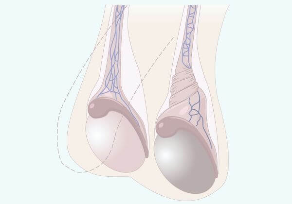 Testicular Torsion Symptoms - Men’s Health Symptoms - 1MD