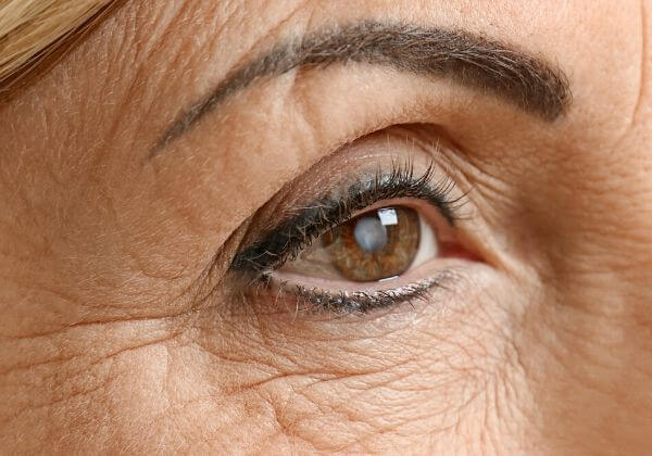 Cataracts: Causes, Treatments, and Long-Term Outlook