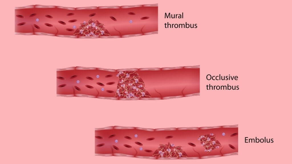 How to break up blood clots