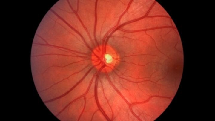 Optic nerve and retina of human eye