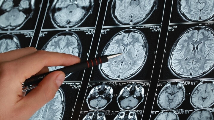 A doctor going over a brain scan