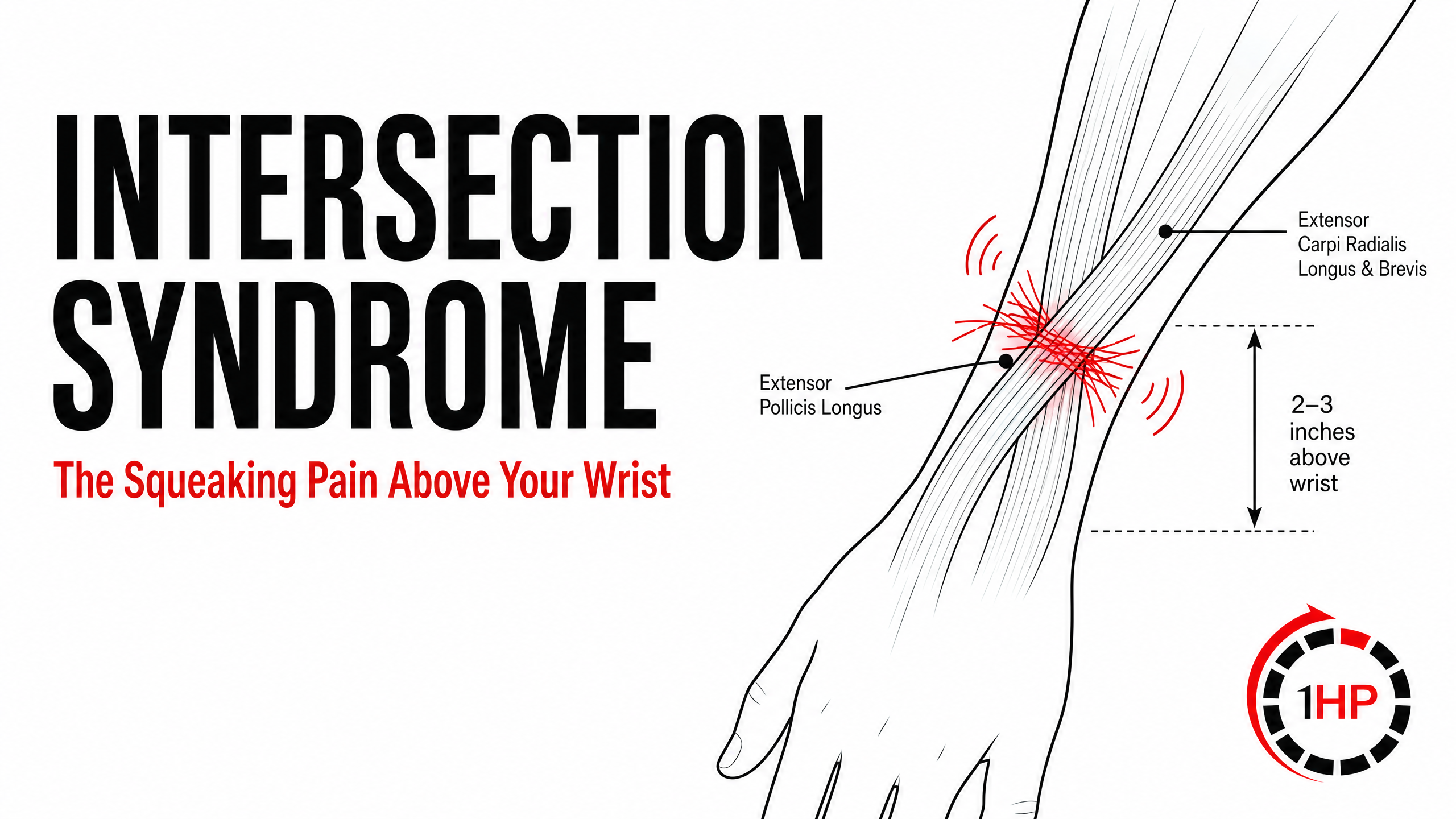 Intersection Syndrome: Causes, Symptoms & Exercises