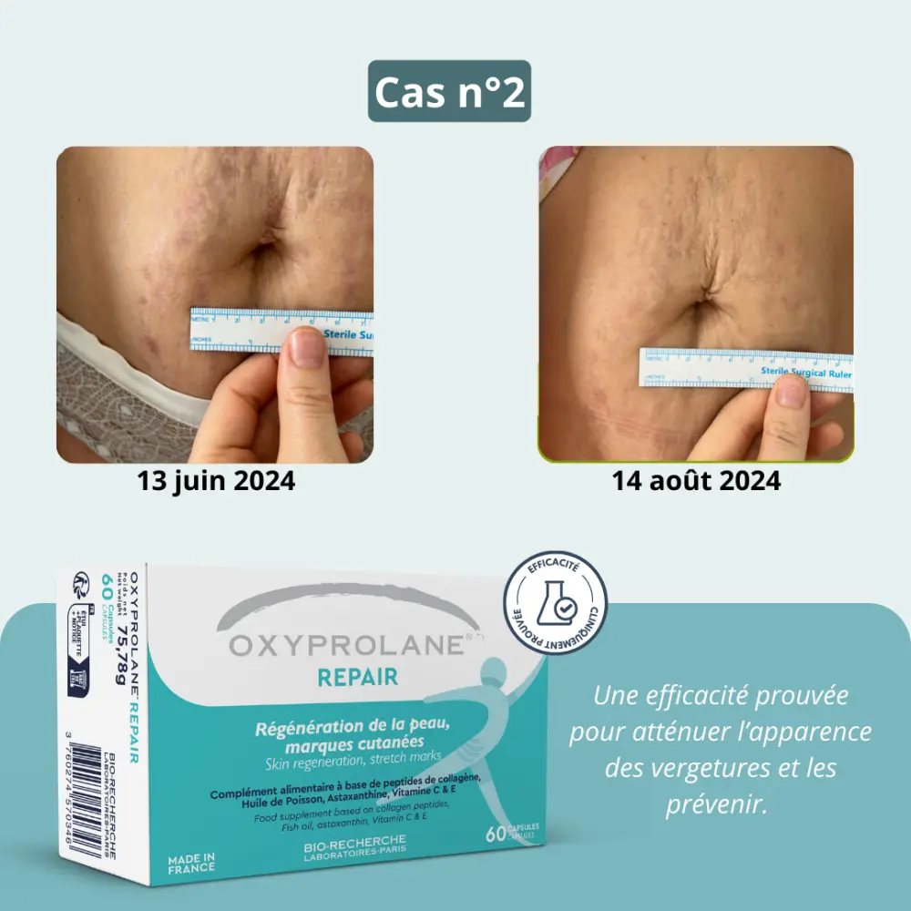 Oxyprolane® Repair - Hautregeneration, Dehnungsstreifen — Bio-Recherche