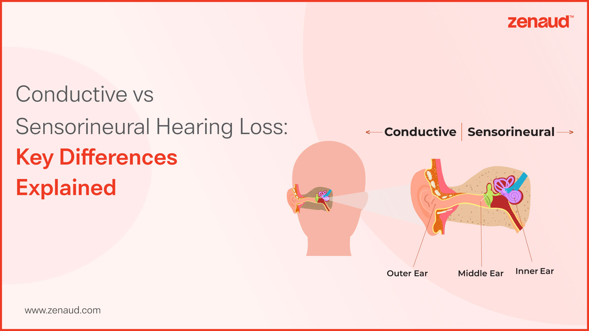 Conductive vs Sensorineural Hearing Loss