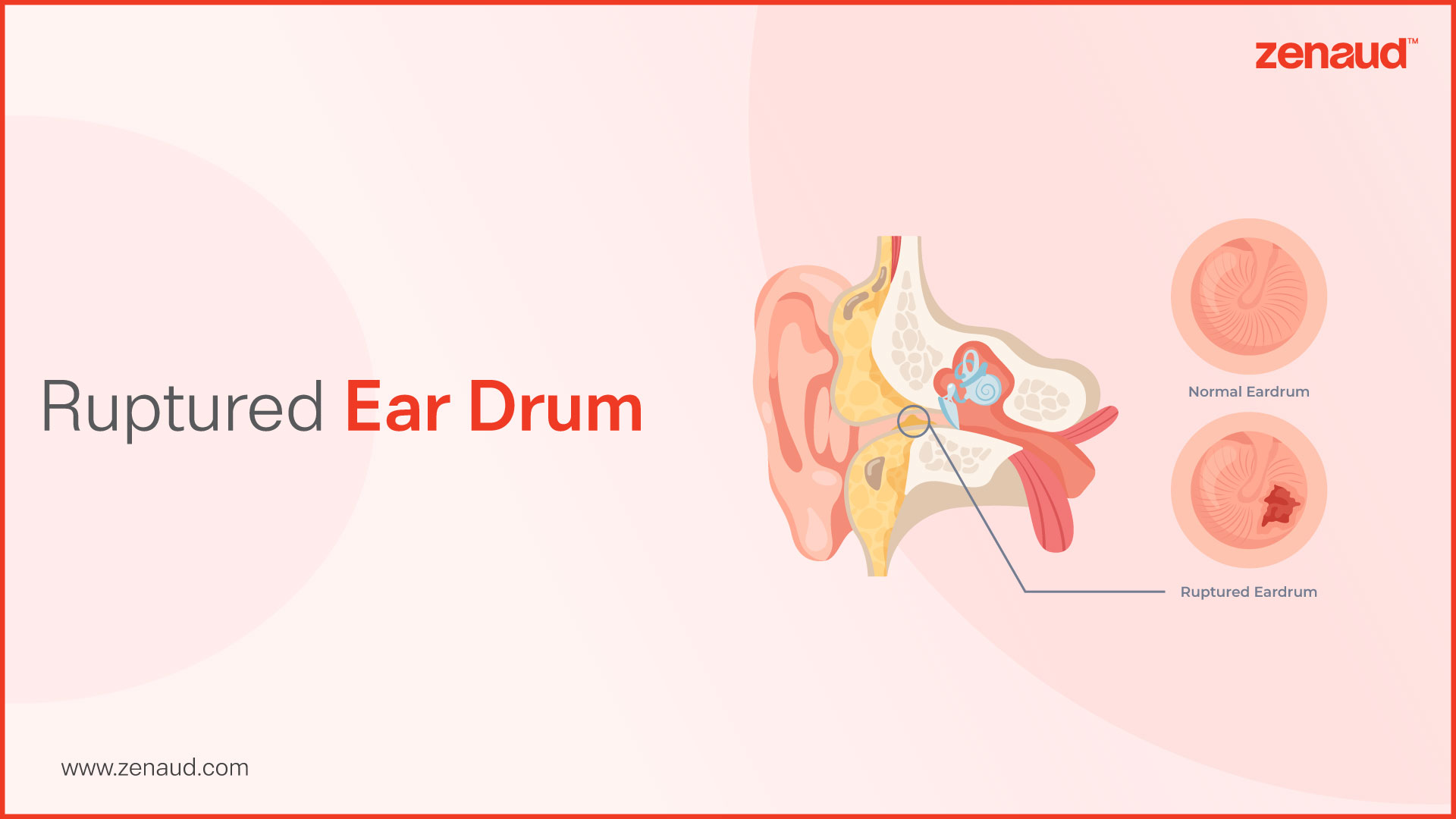 Ruptured Ear Drum