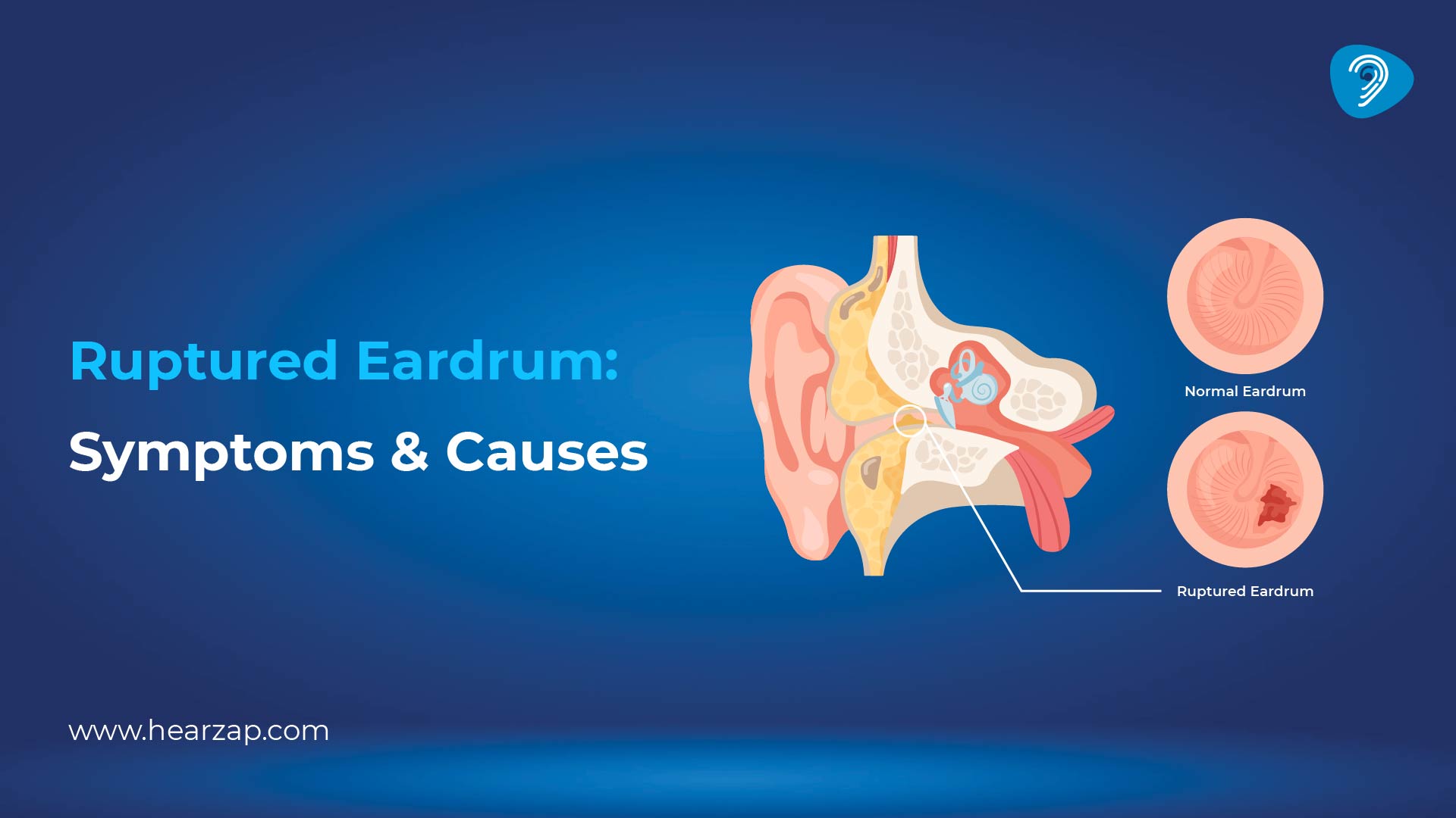 Ruptured Eardrum Symptoms and Causes