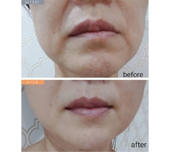 ヒト幹細胞培養上清液（２％）配合　【テラステムクリーム】