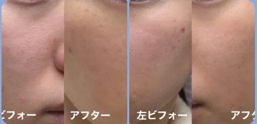 【稼げや祭り 送料半額＋特典🎁】男女OK｜毛穴・ゆらぎ肌を整えるさっぱり美容液｜いつかの美容液
