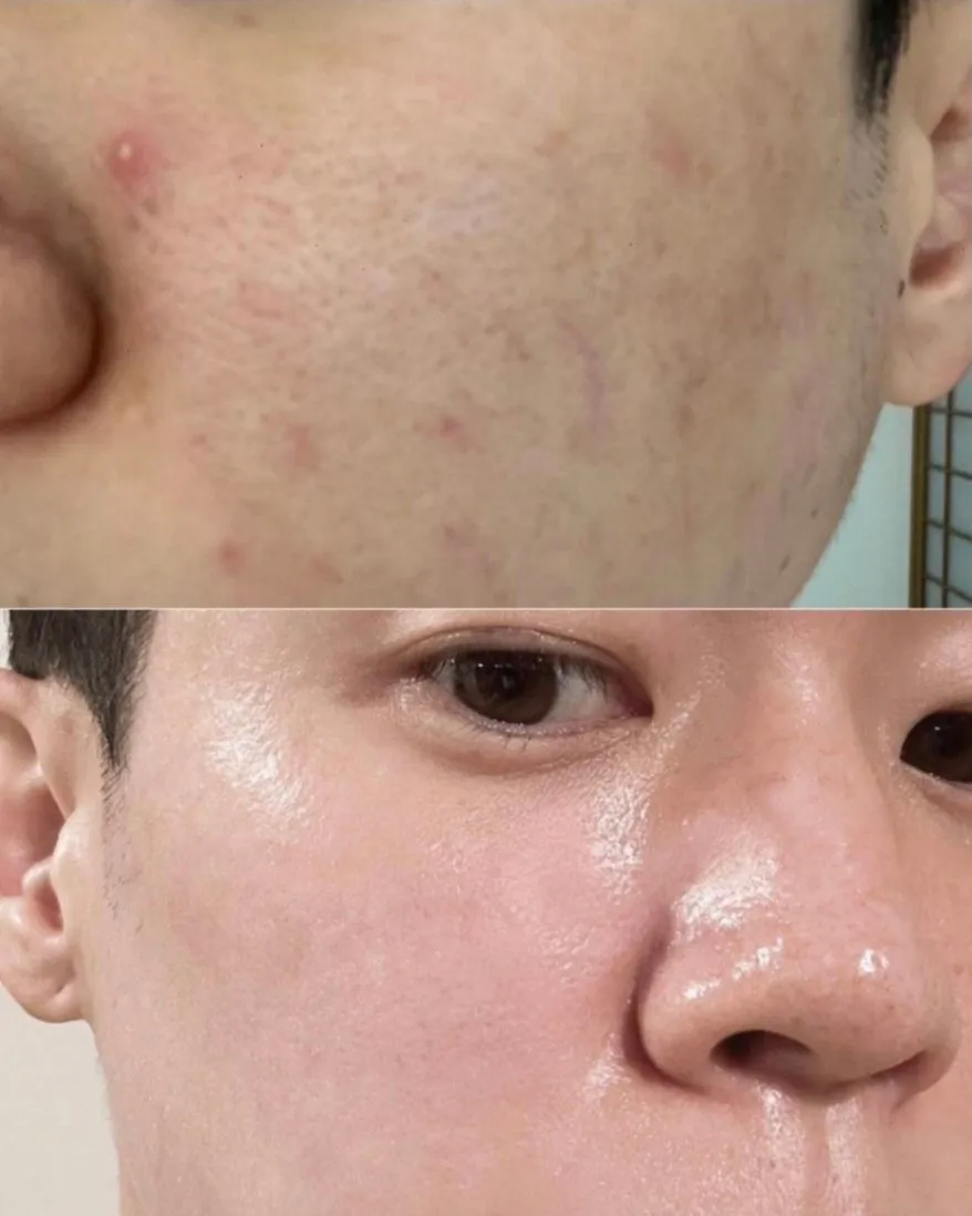 【男性にもおすすめ】1枚3役 毛穴ケア ラダメール ピーリングパッド（ピンプルパッド）
