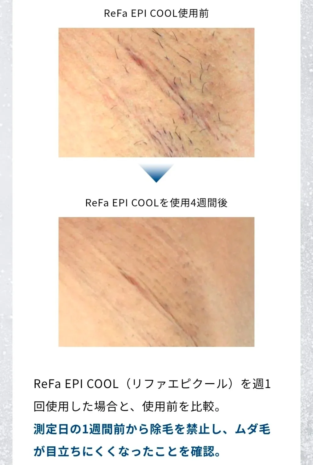 【ReFa 脱毛器】痛みを抑えて自宅で本格ムダ毛ケア｜リファ エピ クール
顔やうなじにもおすすめ✨